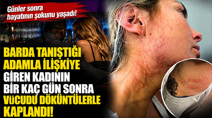 Barda tanıştığı adamla ilişkiye giren kadının bir kaç gün sonra vücudu döküntülerle kaplandı!